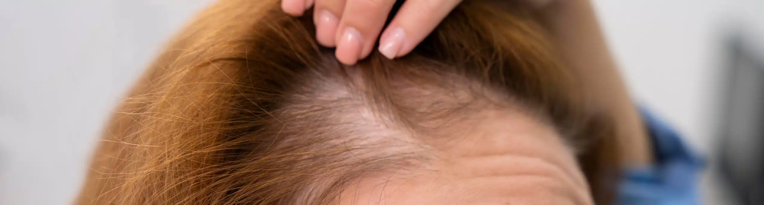 Comment traiter une alopécie de traction ? | Mésothérapie cheveux | Clinique Glaze | Argenteuil
