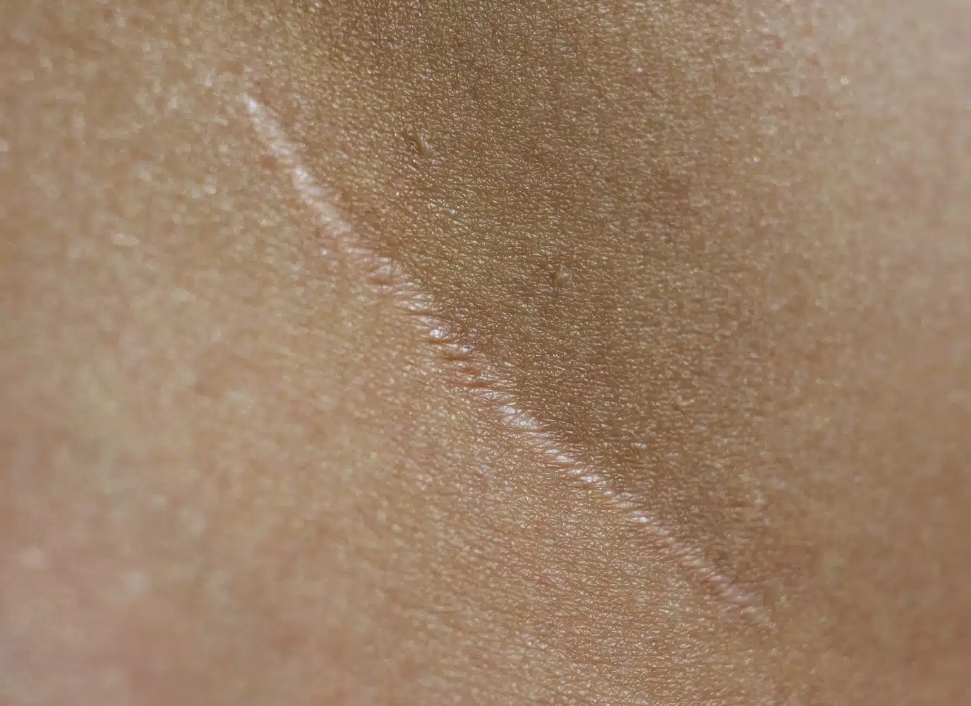 Cicatrices : causes et traitements | Enlever les cicatrices au laser | Clinique Glaze | Argenteuil