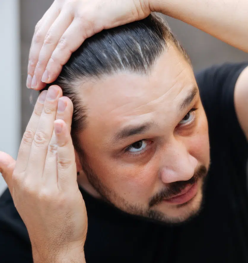 Alopecie