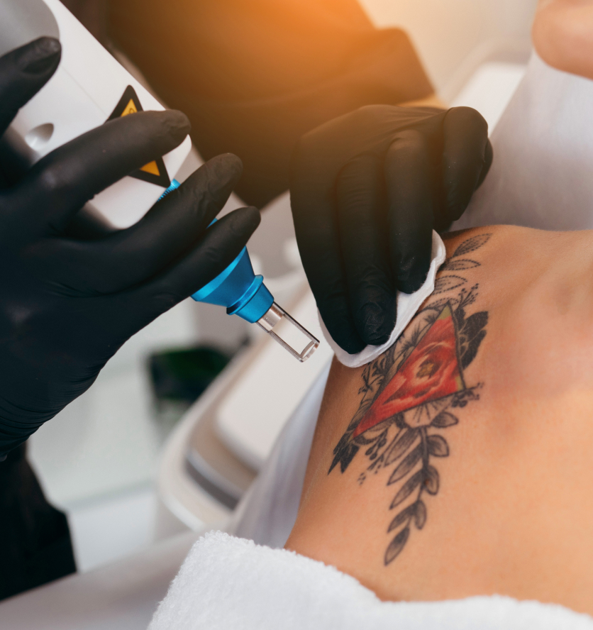 Combien séances nécessaires pour détatouage complet | Glaze | Argenteuil et Sevran