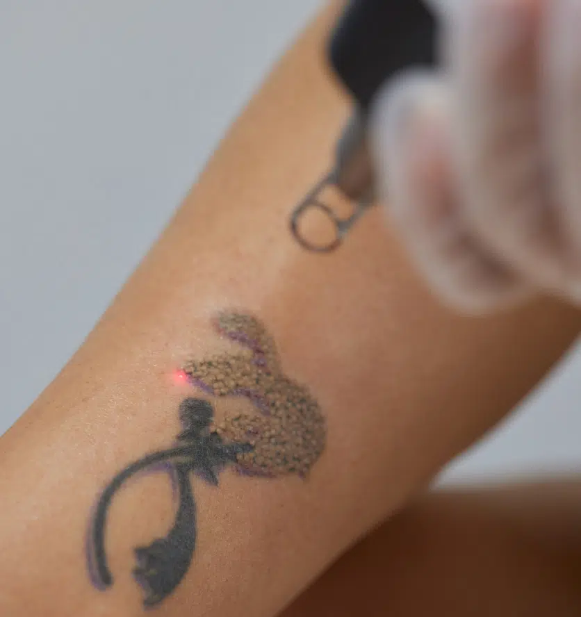 peut-on effacer tatouage fait main | Glaze | Argenteuil et Sevran